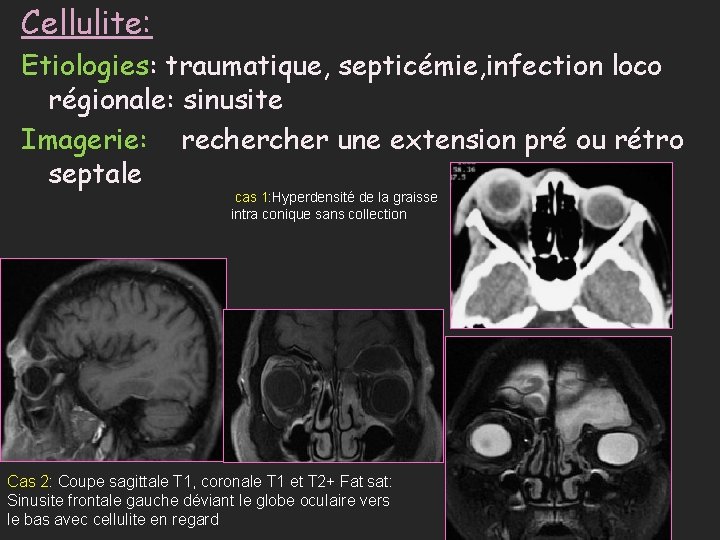 Cellulite: Etiologies: traumatique, septicémie, infection loco régionale: sinusite Imagerie: recher une extension pré ou