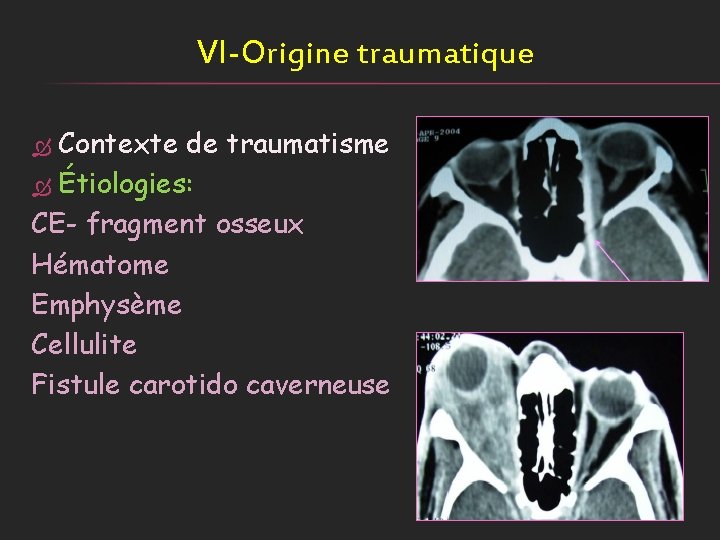 VI-Origine traumatique Contexte de traumatisme Étiologies: CE- fragment osseux Hématome Emphysème Cellulite Fistule carotido