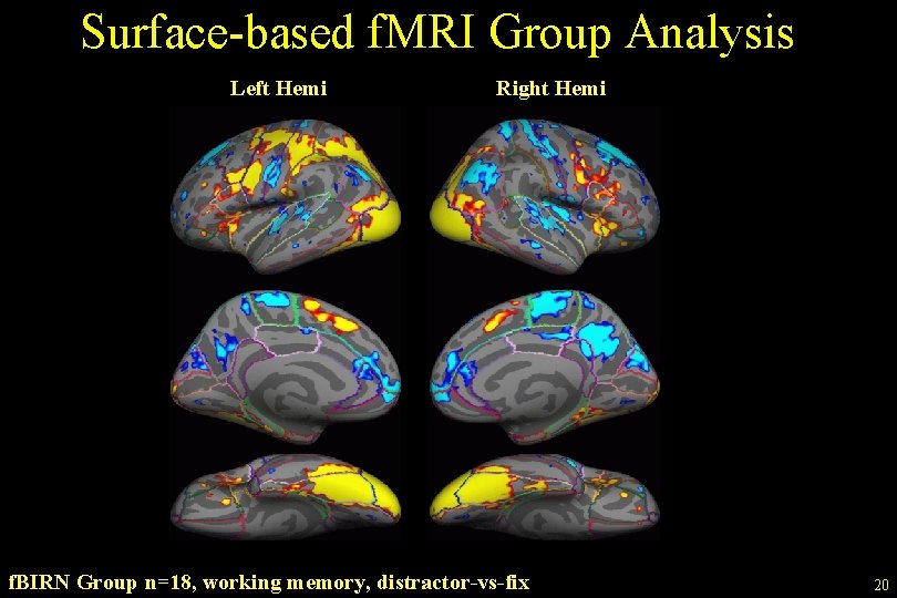 Surface-based f. MRI Group Analysis Left Hemi Right Hemi f. BIRN Group n=18, working