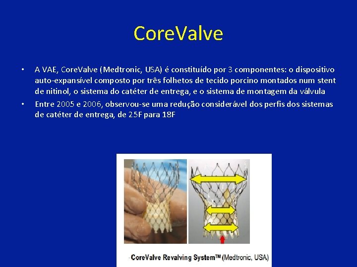 Core. Valve • • A VAE, Core. Valve (Medtronic, USA) é constituído por 3
