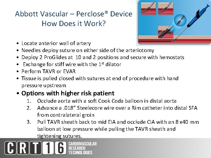 Abbott Vascular – Perclose® Device How Does it Work? • • • Locate anterior