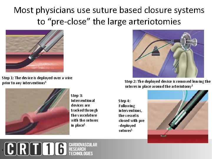 Most physicians use suture based closure systems to “pre-close” the large arteriotomies Step 1: