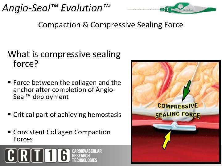 Angio-Seal™ Evolution™ Compaction & Compressive Sealing Force What is compressive sealing force? § Force