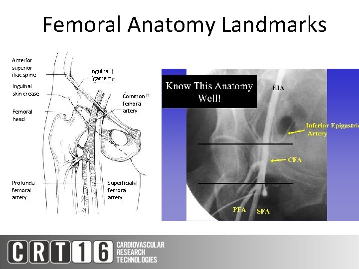 Femoral Anatomy Landmarks Anterior superior iliac spine Inguinal skin crease Femoral head Profunda femoral