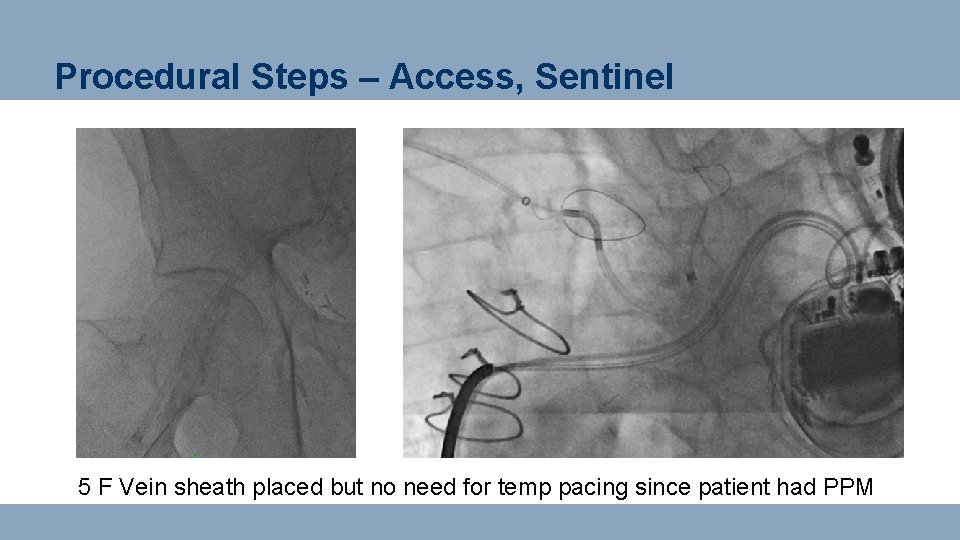 Procedural Steps – Access, Sentinel 5 F Vein sheath placed but no need for