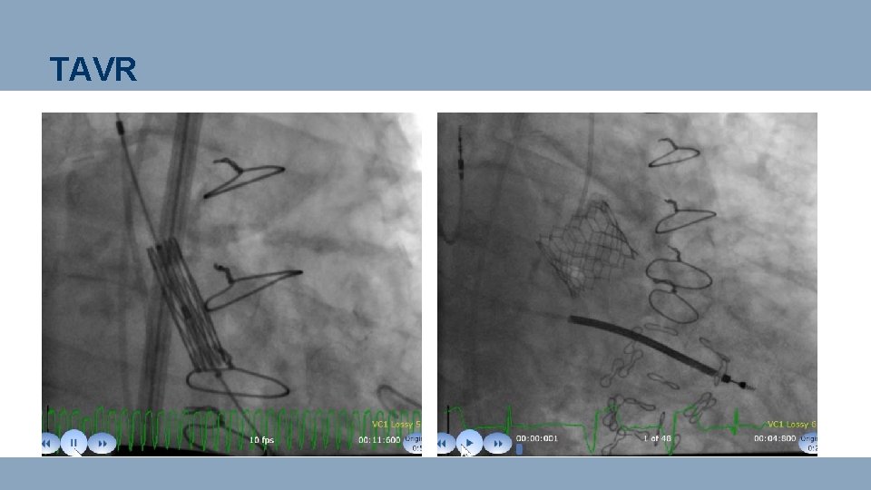 TAVR 