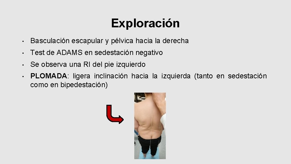 Exploración • Basculación escapular y pélvica hacia la derecha • Test de ADAMS en