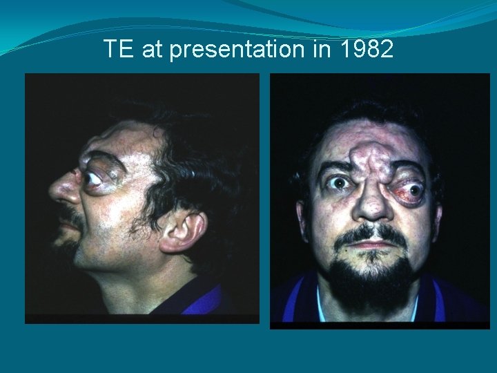 TE at presentation in 1982 