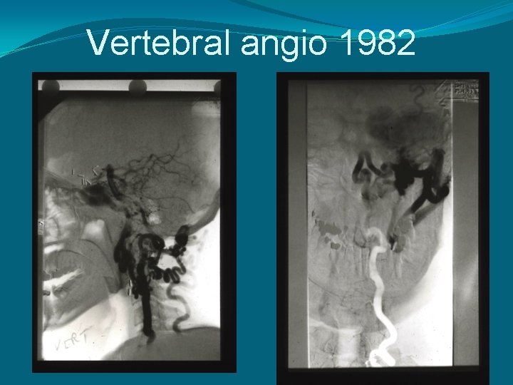 Vertebral angio 1982 