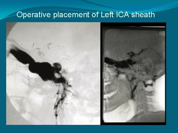 Operative placement of Left ICA sheath 