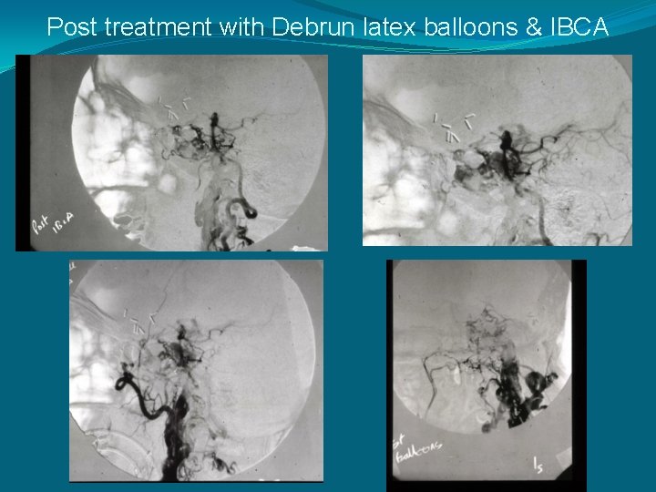 Post treatment with Debrun latex balloons & IBCA 