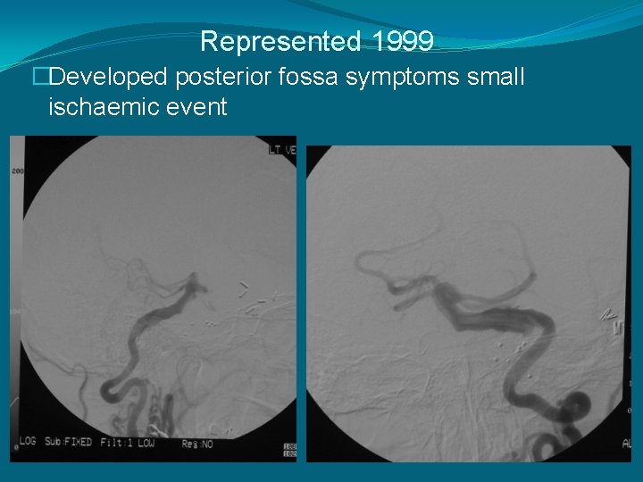 Represented 1999 �Developed posterior fossa symptoms small ischaemic event 
