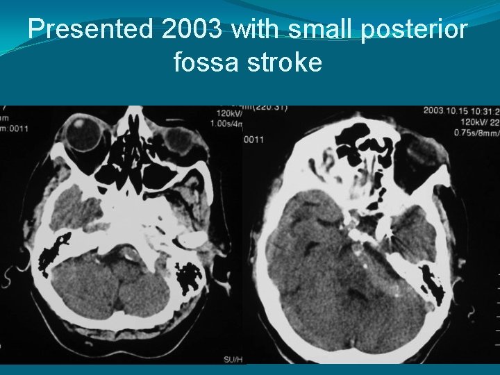 Presented 2003 with small posterior fossa stroke 