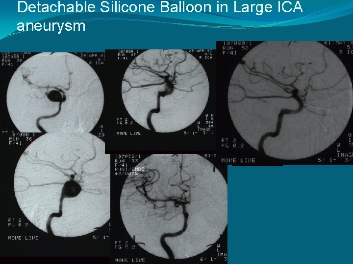 Detachable Silicone Balloon in Large ICA aneurysm 
