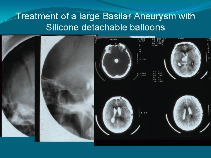Treatment of a large Basilar Aneurysm with Silicone detachable balloons 