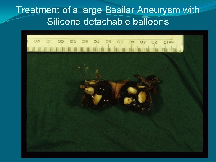 Treatment of a large Basilar Aneurysm with Silicone detachable balloons 