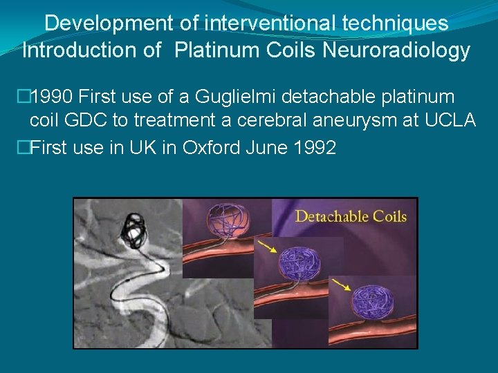 Development of interventional techniques Introduction of Platinum Coils Neuroradiology � 1990 First use of