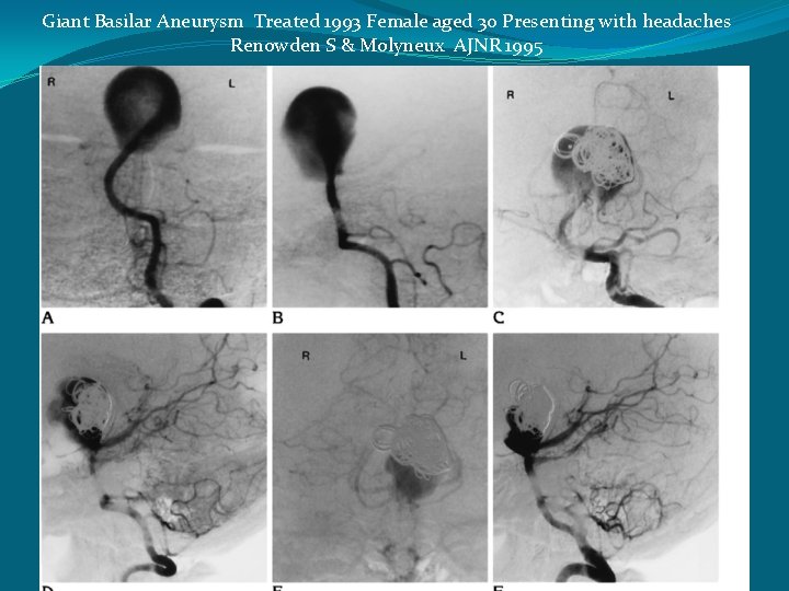 Giant Basilar Aneurysm Treated 1993 Female aged 30 Presenting with headaches Renowden S &