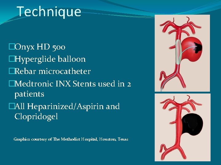 Technique �Onyx HD 500 �Hyperglide balloon �Rebar microcatheter �Medtronic INX Stents used in 2