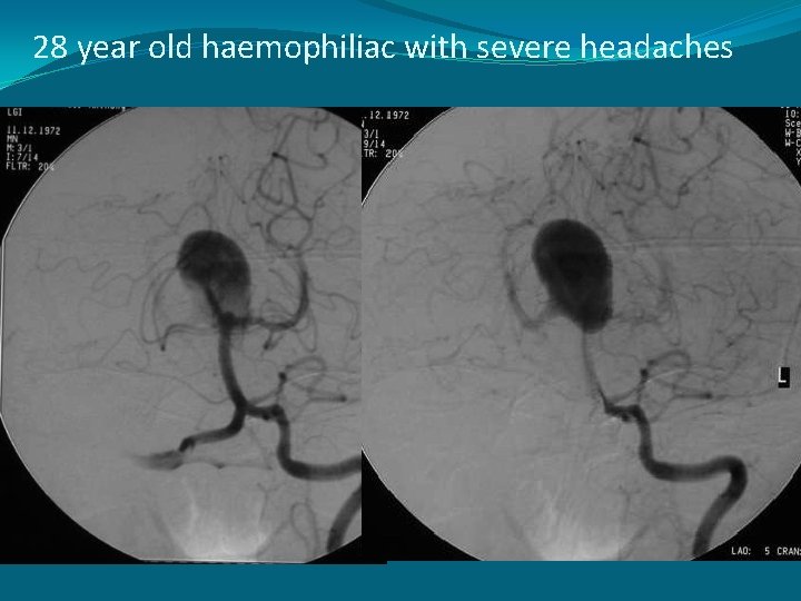 28 year old haemophiliac with severe headaches 