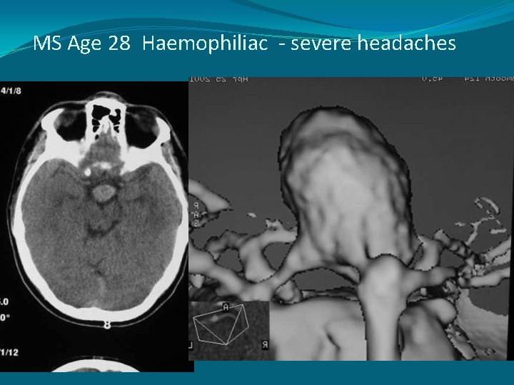 MS Age 28 Haemophiliac - severe headaches 