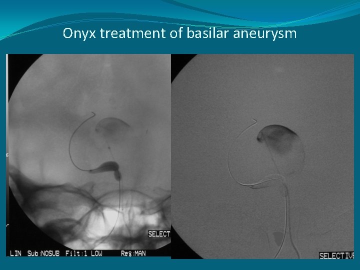 Onyx treatment of basilar aneurysm 