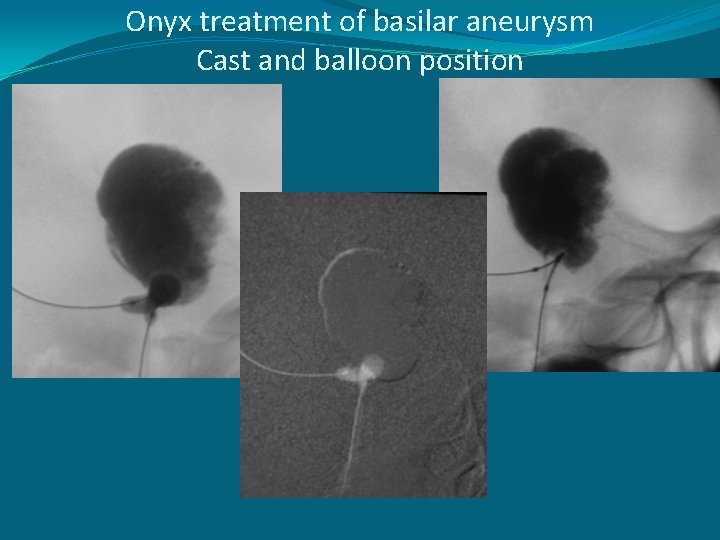 Onyx treatment of basilar aneurysm Cast and balloon position 