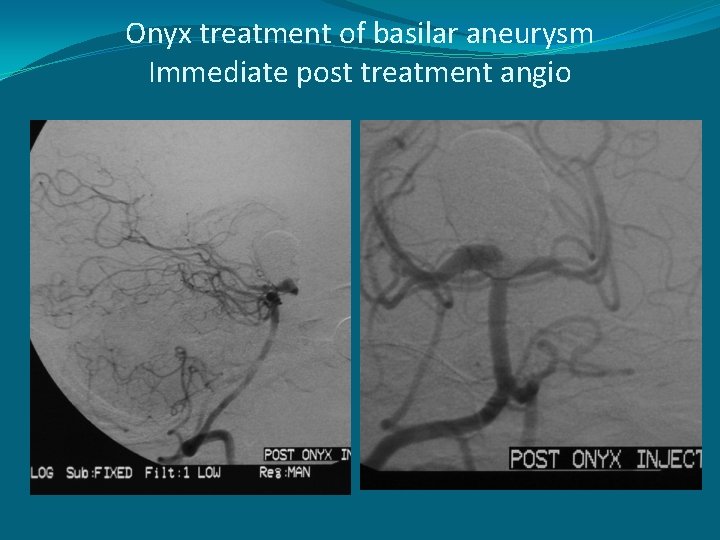 Onyx treatment of basilar aneurysm Immediate post treatment angio 