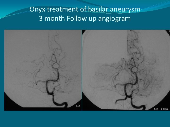 Onyx treatment of basilar aneurysm 3 month Follow up angiogram 