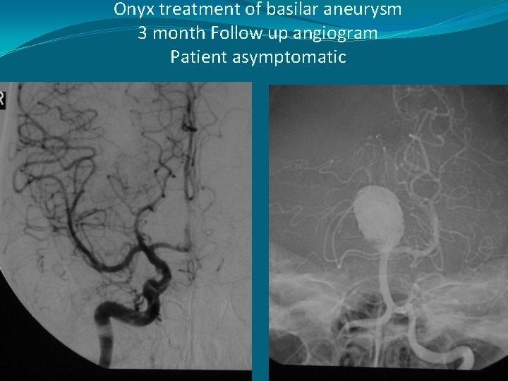 Onyx treatment of basilar aneurysm 3 month Follow up angiogram Patient asymptomatic 