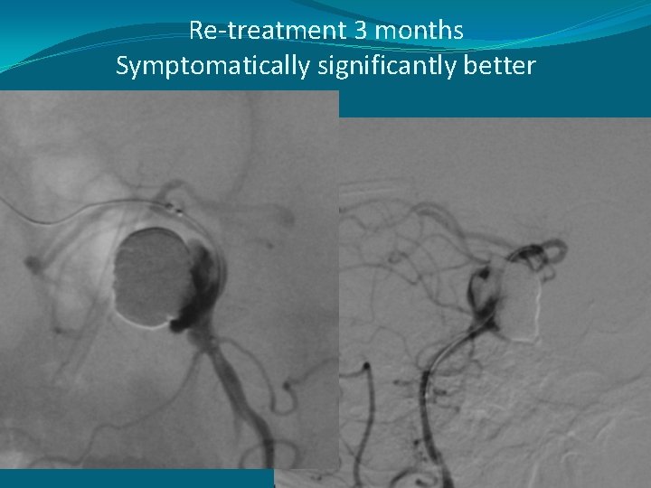 Re-treatment 3 months Symptomatically significantly better 