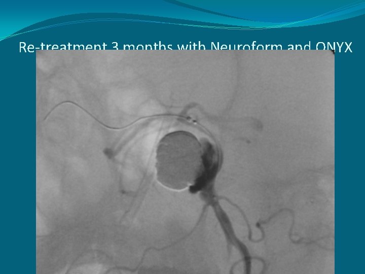 Re-treatment 3 months with Neuroform and ONYX 