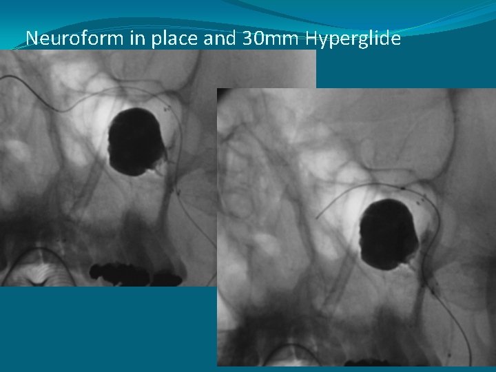 Neuroform in place and 30 mm Hyperglide balloon 
