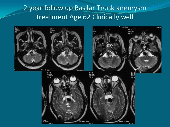 2 year follow up Basilar Trunk aneurysm treatment Age 62 Clinically well 