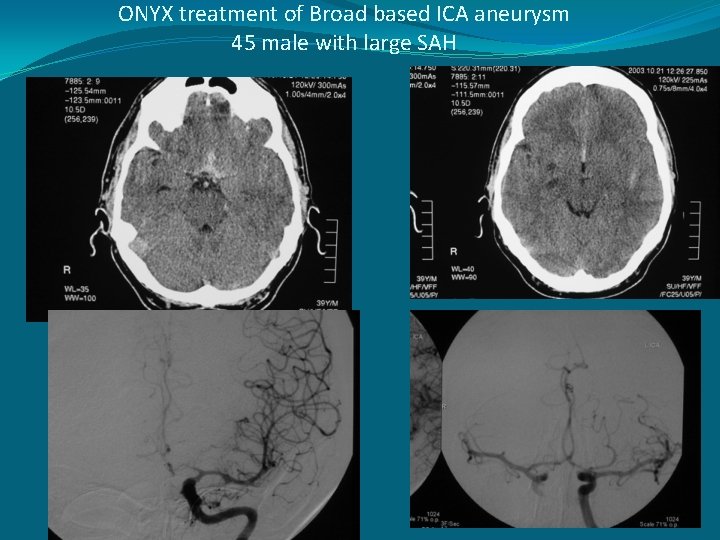 ONYX treatment of Broad based ICA aneurysm 45 male with large SAH 