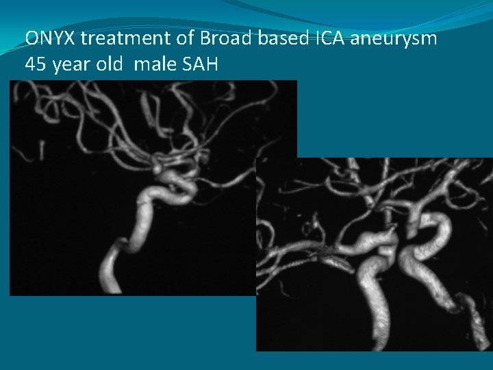 ONYX treatment of Broad based ICA aneurysm 45 year old male SAH 