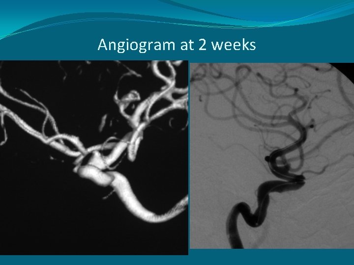 Angiogram at 2 weeks 