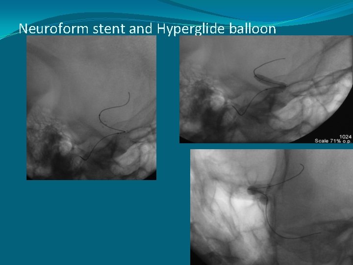 Neuroform stent and Hyperglide balloon 