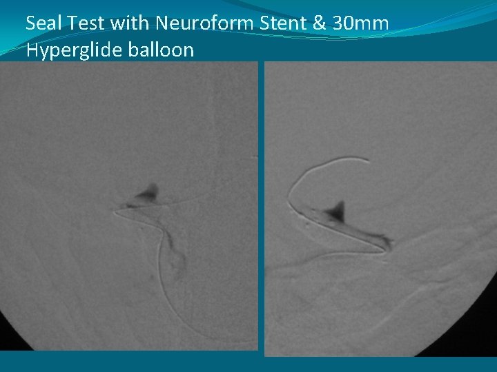 Seal Test with Neuroform Stent & 30 mm Hyperglide balloon 
