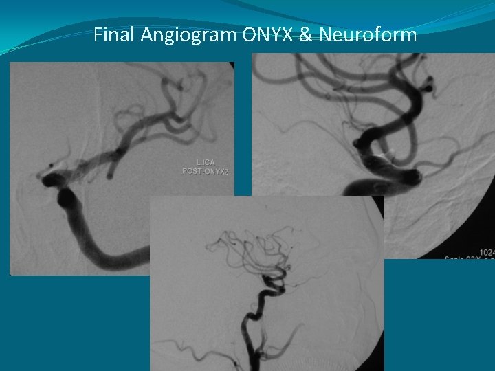 Final Angiogram ONYX & Neuroform 