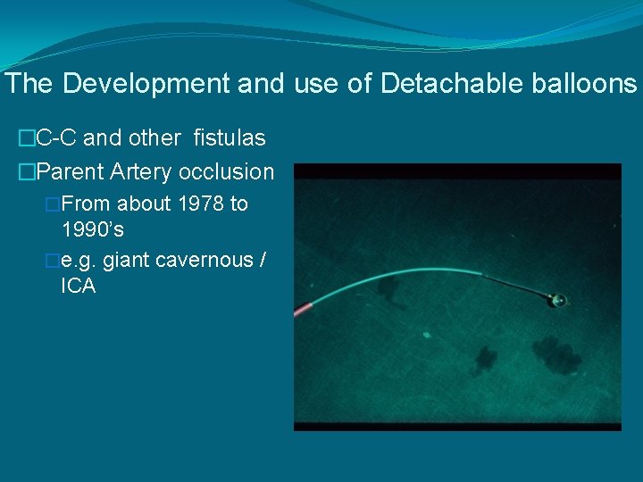 The Development and use of Detachable balloons �C-C and other fistulas �Parent Artery occlusion