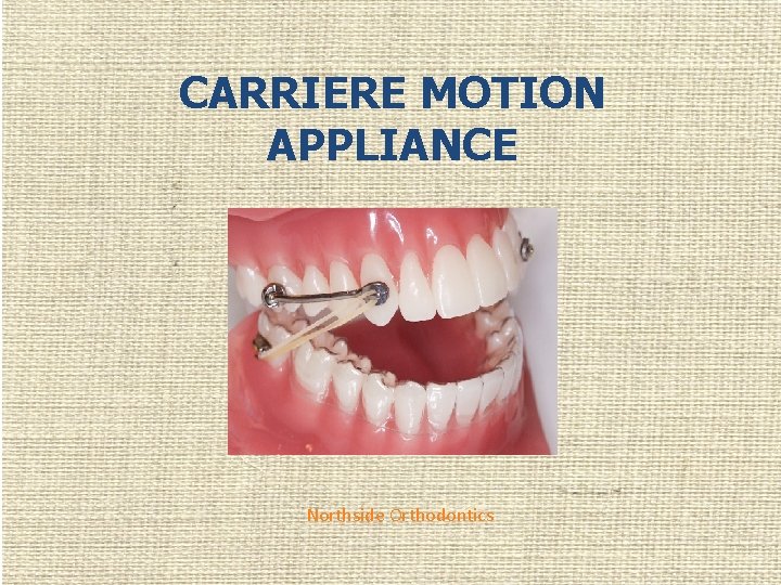 CARRIERE MOTION APPLIANCE Northside Orthodontics 