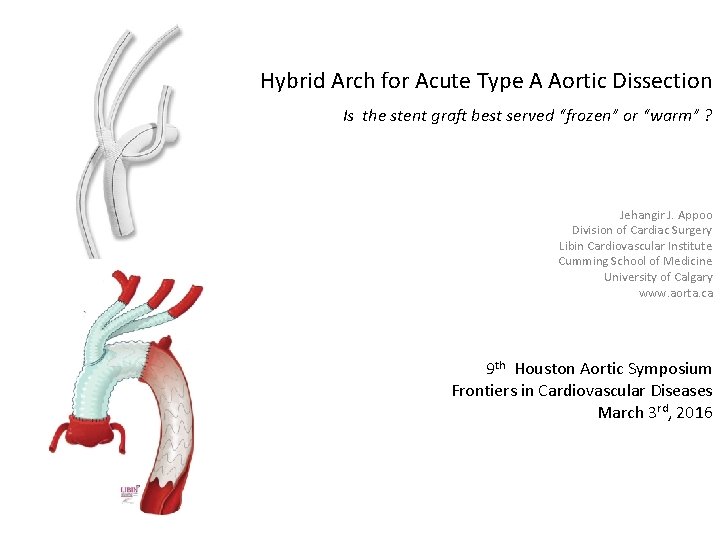 Hybrid Arch for Acute Type A Aortic Dissection Is the stent graft best served