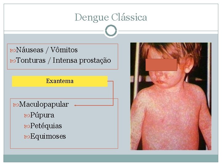 Dengue Clássica Náuseas / Vômitos Tonturas / Intensa prostação Exantema Maculopapular Púpura Petéquias Equimoses