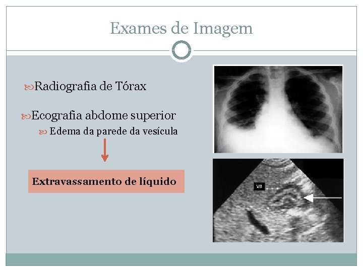 Exames de Imagem Radiografia de Tórax Ecografia abdome superior Edema da parede da vesícula Exames de Imagem Radiografia de Tórax Ecografia abdome superior Edema da parede da vesícula