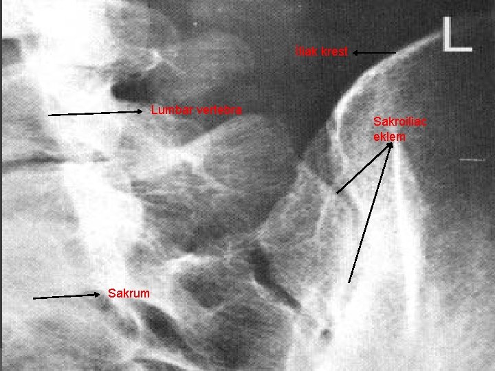 İliak krest Lumbar vertebra Sakrum Sakroiliac eklem 