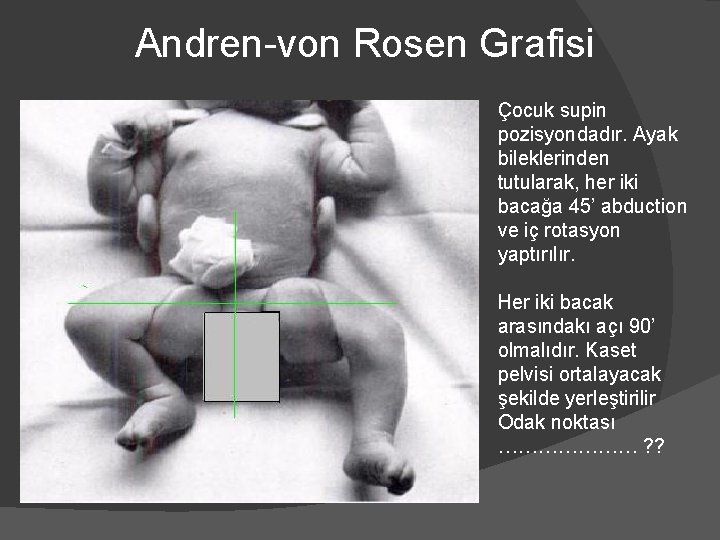 Andren-von Rosen Grafisi Çocuk supin pozisyondadır. Ayak bileklerinden tutularak, her iki bacağa 45’ abduction