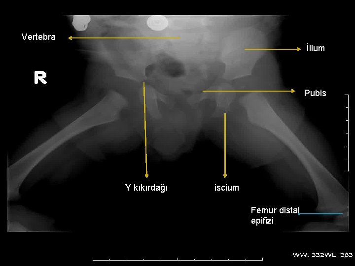 Vertebra İlium Pubis Y kıkırdağı iscium Femur distal epifizi 