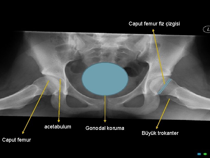 Caput femur fiz çizgisi acetabulum Caput femur Gonodal koruma Büyük trokanter 