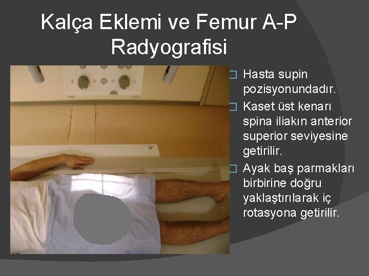 Kalça Eklemi ve Femur A-P Radyografisi Hasta supin pozisyonundadır. � Kaset üst kenarı spina